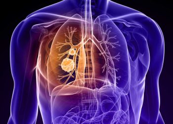 El estigma sigue impidiendo el diagnóstico oportuno de cáncer de pulmón