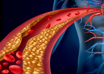 Disminuir niveles de colesterol “malo” evitaría desarrollo de aterosclerosis
