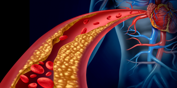 Disminuir niveles de colesterol “malo” evitaría desarrollo de aterosclerosis