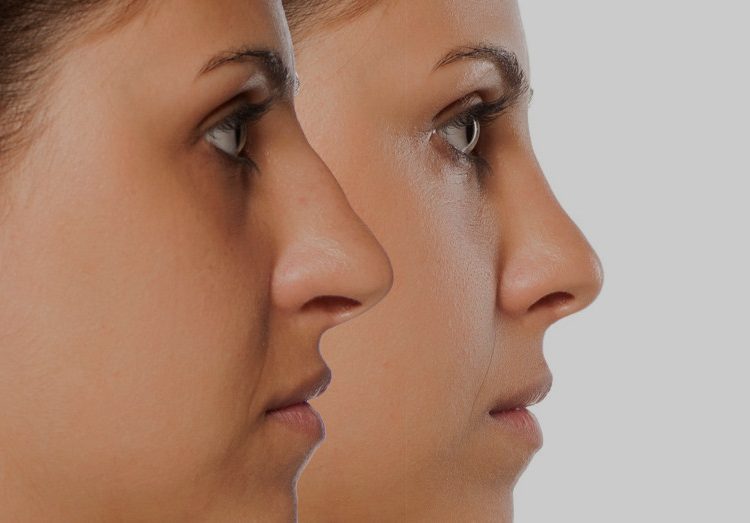 comparative portrait of a young woman before and after nose correction