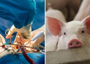 Trasplantan riñones de cerdo modificados genéticamente a un humano
