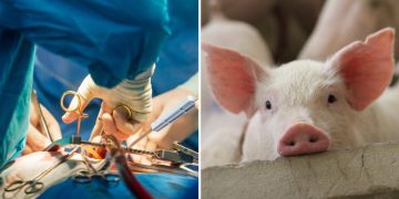 Trasplantan riñones de cerdo modificados genéticamente a un humano
