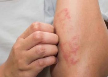 En 24 países del continente americano han sido detectados casos de lepra, de acuerdo con la OPS