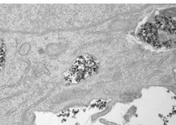 Nanopartículas magnéticas de metal, armas en la lucha contra el cáncer