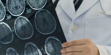 Descubren utilidad de fármacos para la hipertensión para un cáncer cerebral
