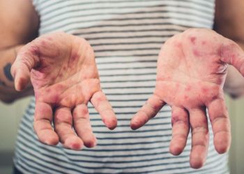 La ONU alerta de un aumento del 79% en los casos de sarampión a nivel mundial