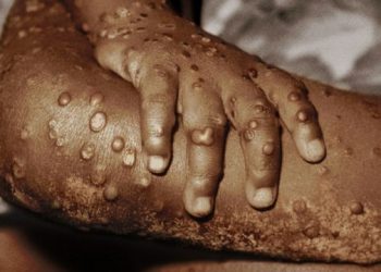 México emite aviso epidemiológico por viruela del mono