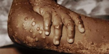 México emite aviso epidemiológico por viruela del mono