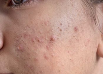 Logran reducir las cepas de las bacterias de la piel que causan el acné