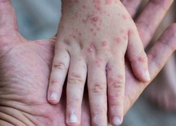 Autoridades detectan un posible caso de viruela del mono en Florida