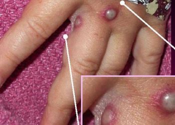 Francia vacunará a las personas en contacto con casos de viruela del mono