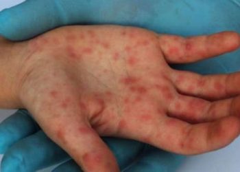 Ya son 17 los casos de posible viruela de mono que revisa Canadá