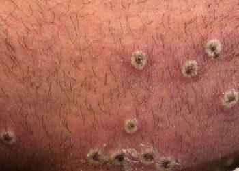 Israel detecta un primer caso sospechoso de viruela del mono