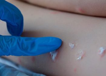 Argentina reporta su primer caso sospechoso de viruela del mono