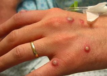 Viruela del mono llega a Latinoamérica; Argentina confirma primer caso