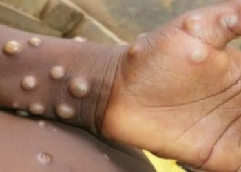 Canadá estudia 17 posibles casos de la viruela del mono