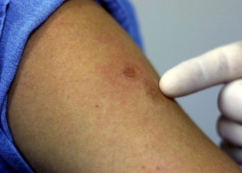 Estados Unidos contabiliza un caso confirmado de viruela del mono y cuatro sospechosos