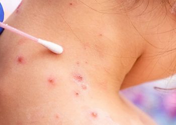 Argentina reporta su primer caso sospechoso de viruela del mono