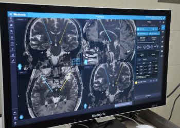 Personas con Parkinson pueden vivir sin síntomas de 15 a 20 años