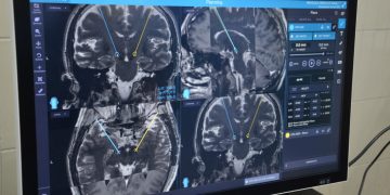 Personas con Parkinson pueden vivir sin síntomas de 15 a 20 años