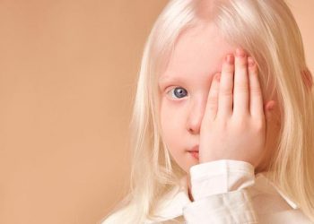 Día Internacional de Sensibilización sobre el Albinismo: concientizar para prevenir el bullying