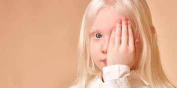 Día Internacional de Sensibilización sobre el Albinismo: concientizar para prevenir el bullying