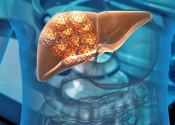Médicos piden atender el hígado graso, enfermedad que afecta al 50% de mexicanos