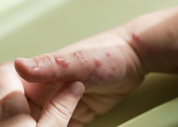 La OMS eleva a 643 los casos de viruela del mono en el mundo