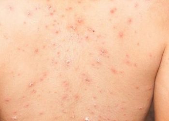 OPS espera más casos de la viruela del mono, pero el riesgo aún es bajo