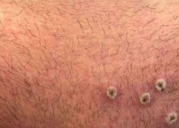 Comité de Emergencia de OMS evaluará nuevamente el brote de viruela del mono