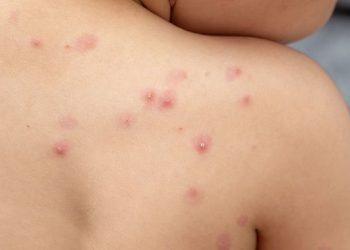 Se registran dos casos de viruela del mono en el Estado de México