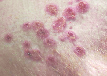 Estados Unidos considera que es esencial una acción coordinada contra la viruela del mono