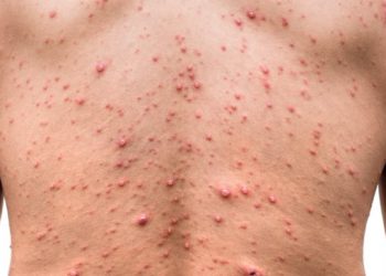 En Colima se detecta el primer caso de viruela del mono