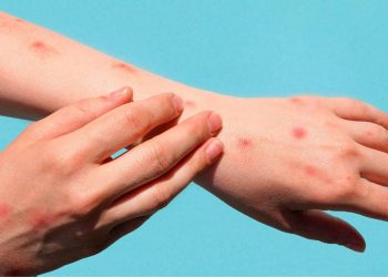 Estados Unidos tiene registrados casi 3,000 casos de viruela del mono