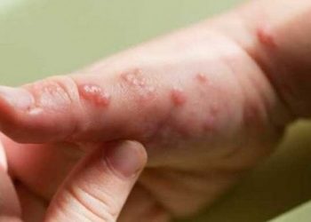 OMS: Casos globales de viruela del mono ascienden a 14,000