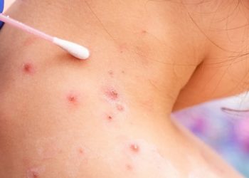 OMS analiza si declarar emergencia internacional por viruela del mono