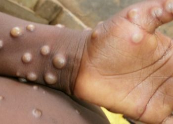 La EMA recomienda formalmente la vacuna Imvanex para la viruela del mono