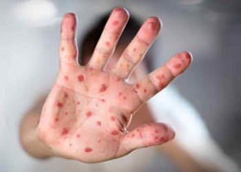 Profesionales de la salud reciben capacitación sobre viruela del mono