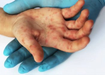 Suman 386 contagios de viruela del mono en México