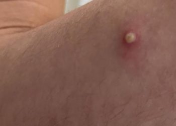 El 40% de pacientes con viruela del mono sufren complicaciones, sugiere estudio