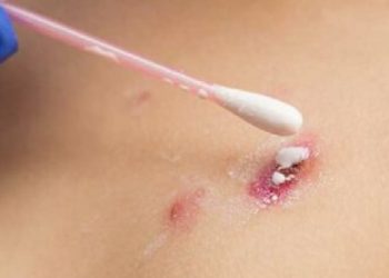 Estados Unidos supera a España en contagios de viruela del mono