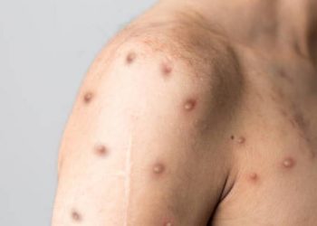 Reportan tercer caso de viruela del mono en Chihuahua