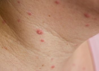 Estados Unidos declarará emergencia sanitaria nacional por la viruela del mono