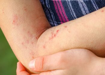 Casos de viruela del mono bajan a nivel mundial, pero aumentan en América