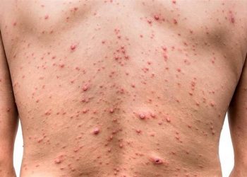 Brote de viruela del mono se debe a contagio entre personas: OMS