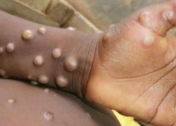 India confirma el primer fallecimiento de un paciente de viruela del mono