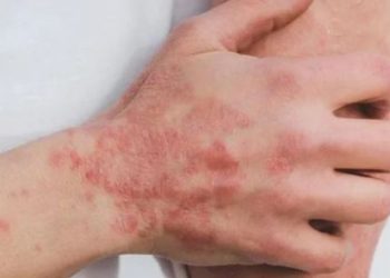 Aumentan los casos de viruela del mono en México