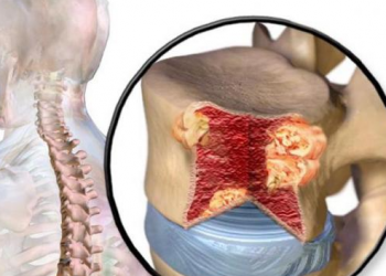 ¿Sabías que cada año se detectan en México mil 500 casos de mieloma múltiple?