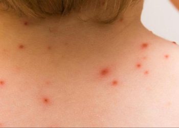 ¿Cómo va la pandemia de viruela del mono en el mundo? Esto dice la OMS