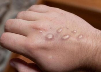 Esta ciudad de Estados Unidos registró su primera muerte por viruela del mono